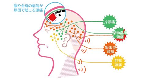 頭頂頭痛 原因|頭頂部の頭痛に関連する5つの病気